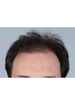 Before Hair Transplant&nbsp;Front